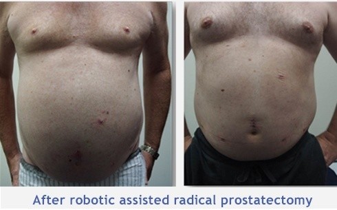 After robotic assisted radical prostatectomy